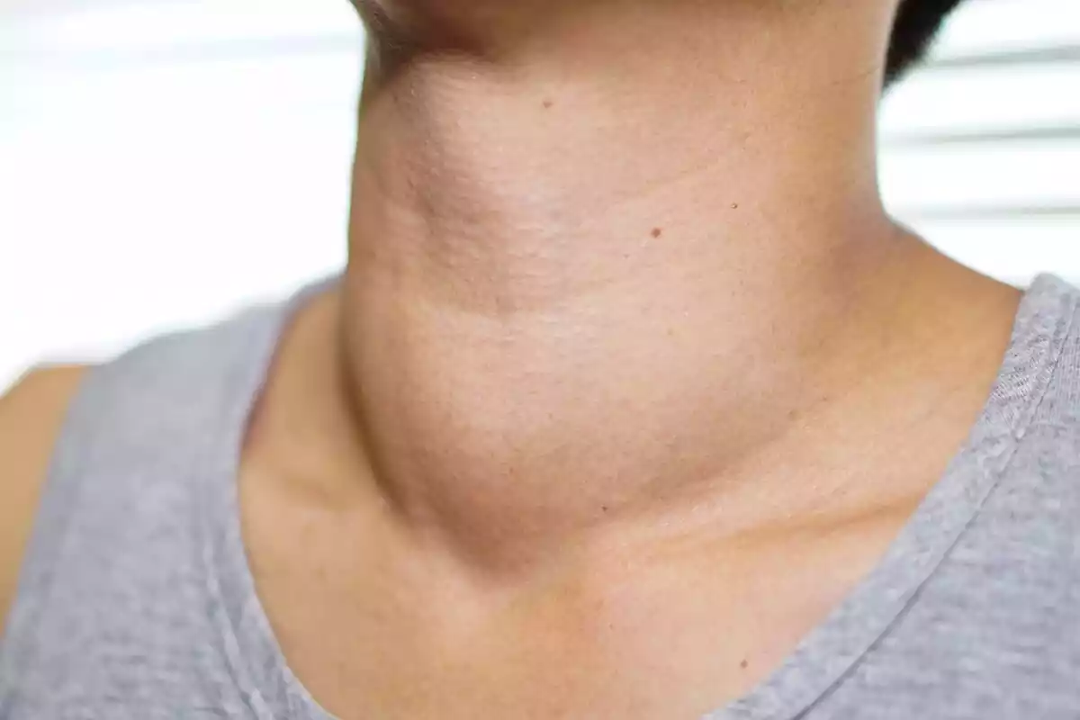 El cuello de una mujer con hipertiroidismo