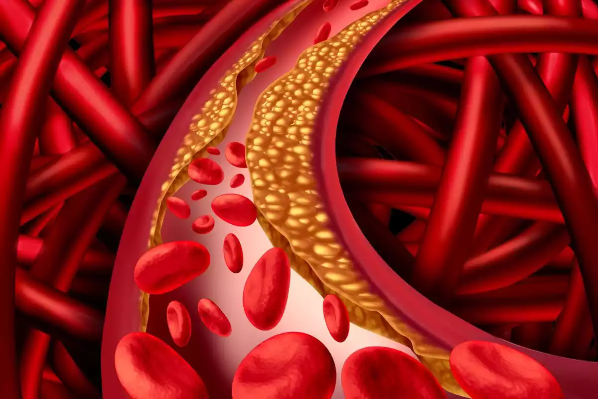 Arteria obstruida por colesterol y grasas