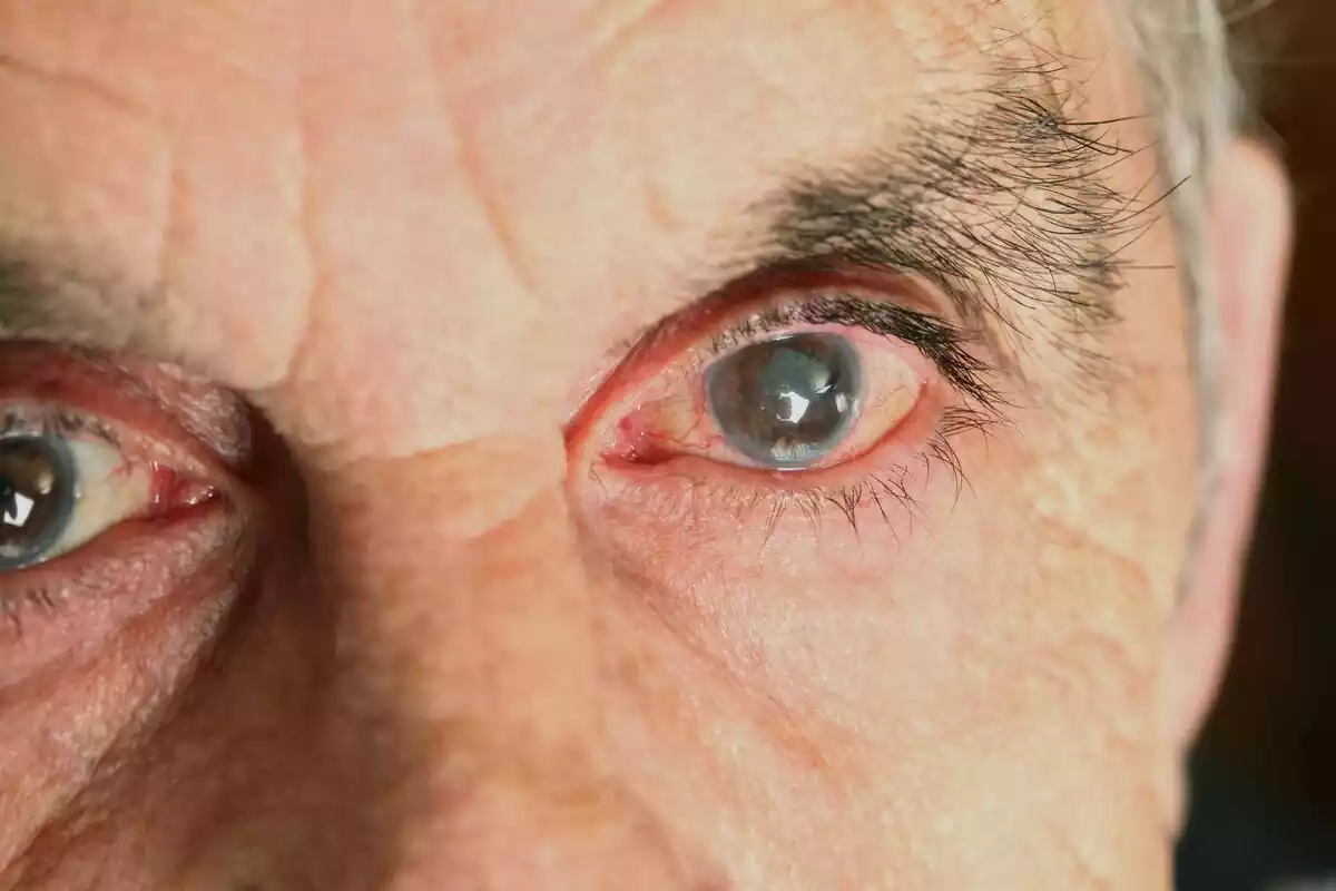 Hombre con cataratas en los ojos