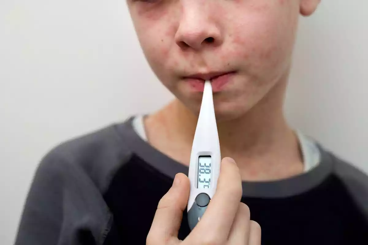 Niño con termómetro en la boca y sarampión