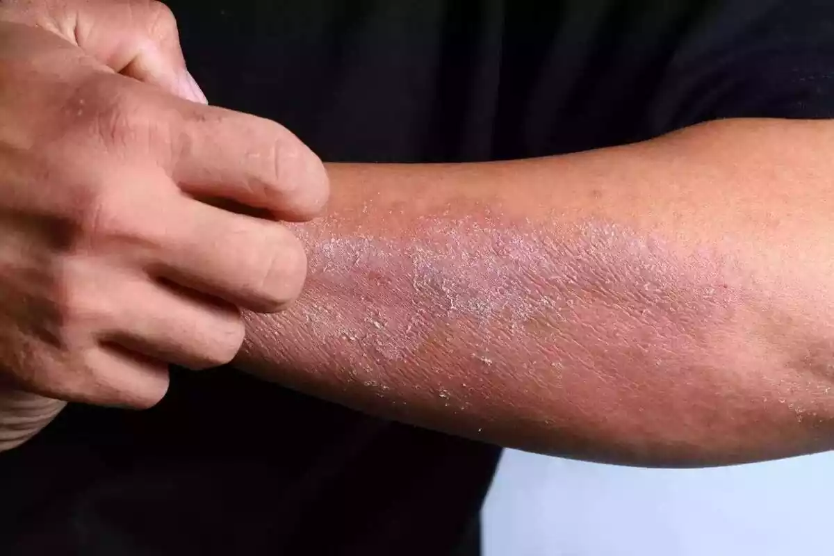 Enfermedades de la piel: sarna